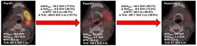 Prognostic significance of fludeoxyglucose positron emission tomography delta radiomics following bridging therapy in patients with large B-cell lymphoma undergoing CAR T-cell therapy